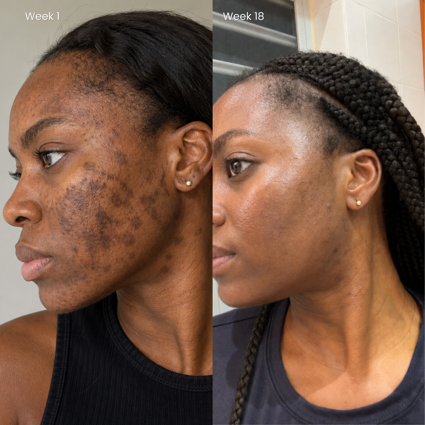 Puryvea dark spot cream — hyperpigmentation, melasma, post-acne marks