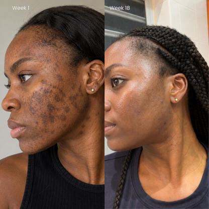 Puryvea dark spot cream — hyperpigmentation, melasma, post-acne marks