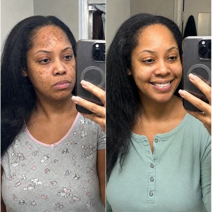 Puryvea dark spot corrector — face, dark spots and melasma