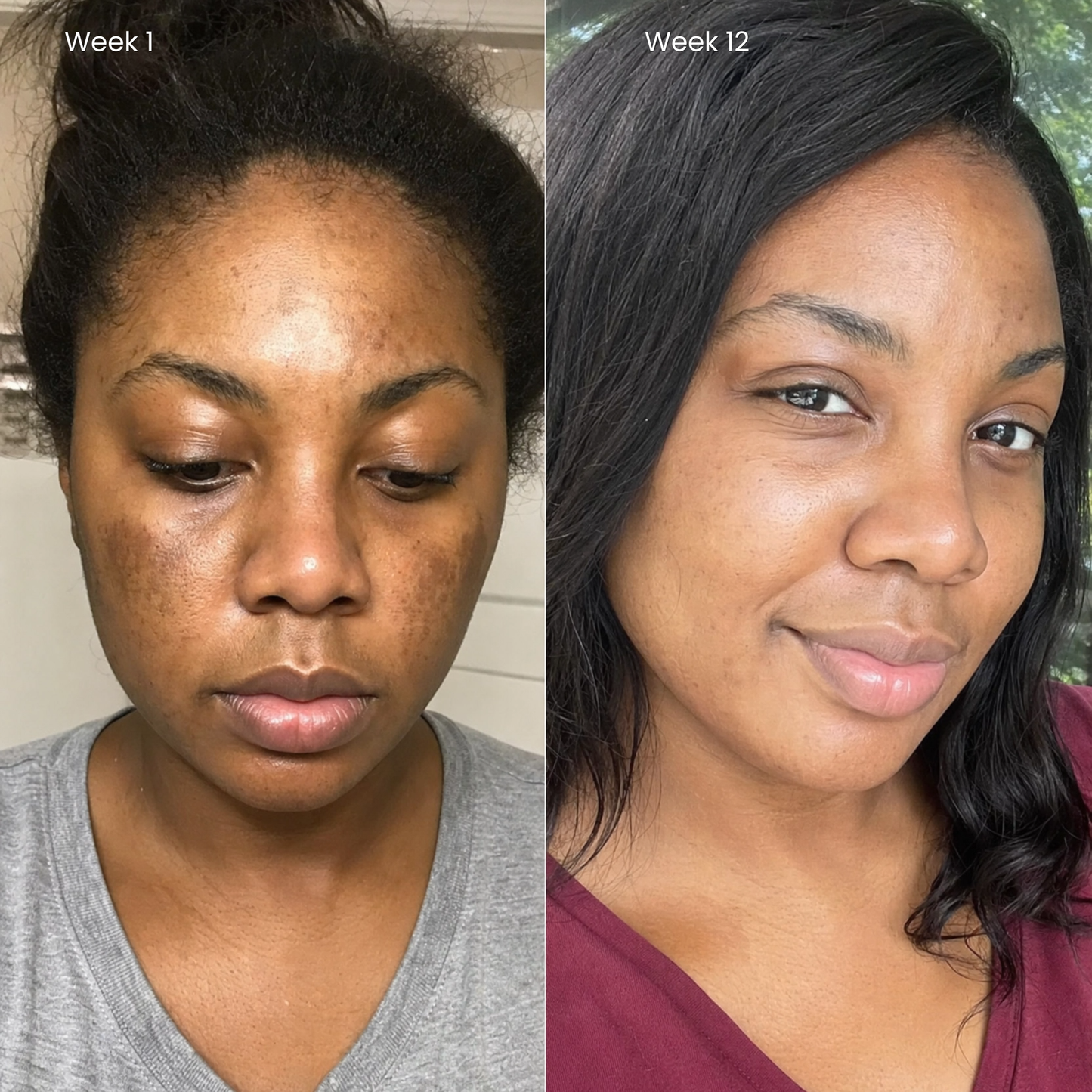 Puryvea dark spot cream — Alpha-Arbutin and Tranexamic Acid