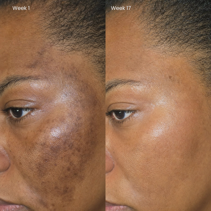 Puryvea dark spot treatment for melanin-rich skin